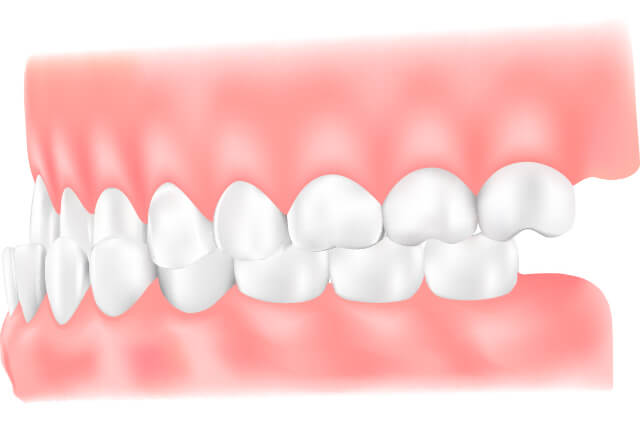 反対咬合（はんたいこうごう）のイラスト